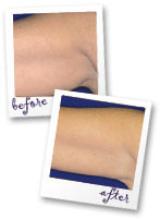 Revitol Cellulite Solution